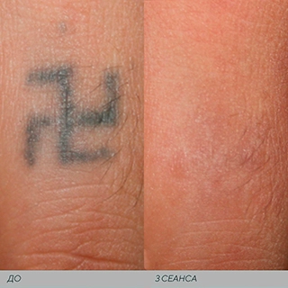 Фото удаление татуировок лазером